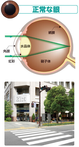 白内障イメージ画像