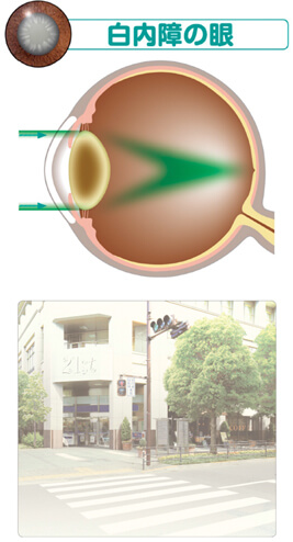 白内障イメージ画像