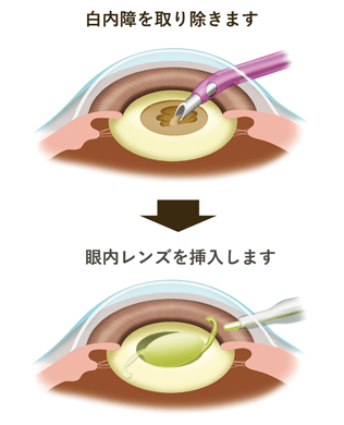 白内障手術イメージ画像