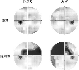 緑内障における視野欠損