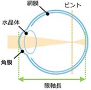 近視イメージ画像