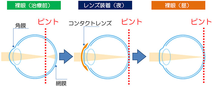 オルソケラトロジーイメージ画像