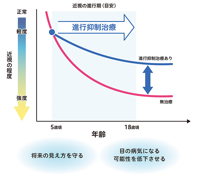 オルソケラトロジーイメージ画像