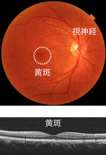 正常な網膜