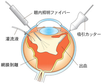 硝子体手術